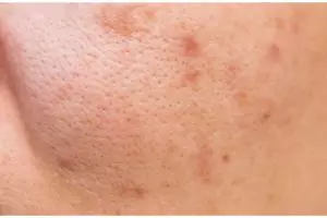 Tanpa pakai es batu, ini cara bersihkan pori-pori wajah agar bebas komedo gunakan 1 jenis pemanis