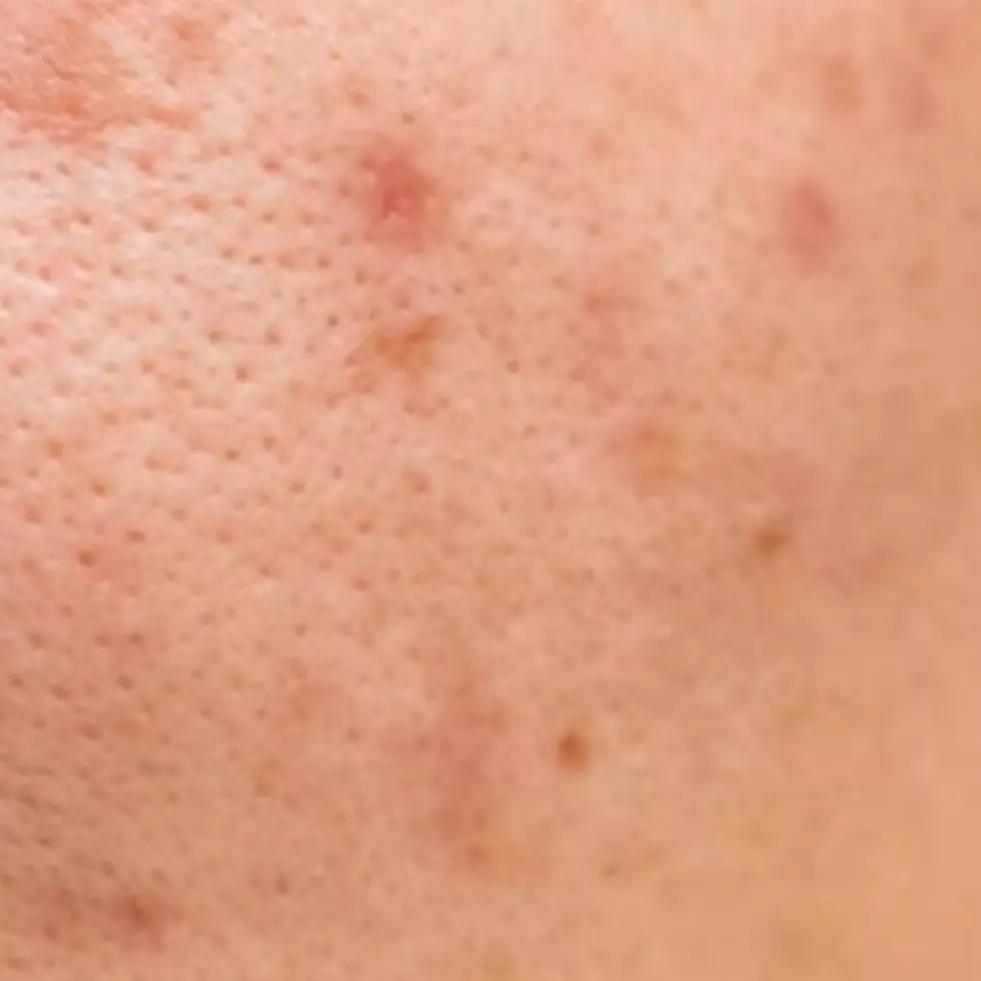 Tanpa pakai es batu, ini cara bersihkan pori-pori wajah agar bebas komedo gunakan 1 jenis pemanis