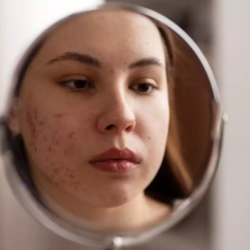 Tanpa kulit pisang, ini trik basmi flek hitam pada wajah kusam pakai 1 produk fermentasi