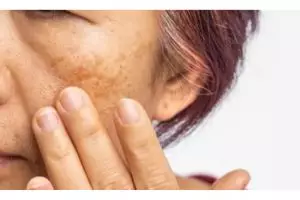 Tanpa serum vitamin C, ini trik usir flek hitam agar wajah jadi glowing pakai 1 sumber karbohidrat