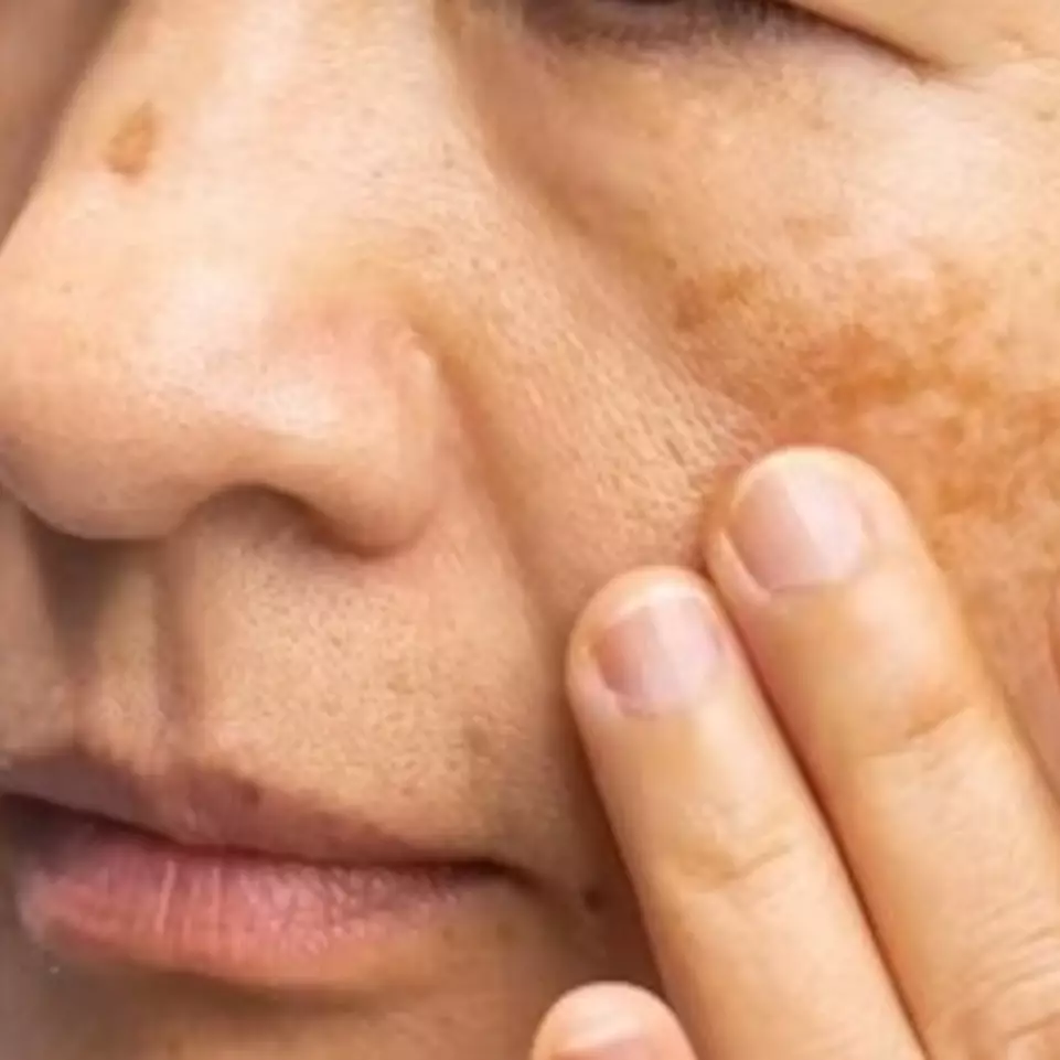 Tanpa serum vitamin C, ini trik usir flek hitam agar wajah jadi glowing pakai 1 sumber karbohidrat