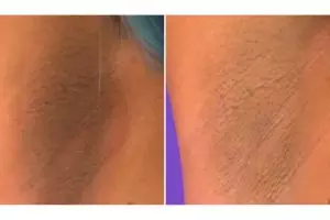 Tanpa kopi atau jeruk nipis, ini trik memutihkan ketiak hitam hanya dengan 1 jenis produk olahan susu