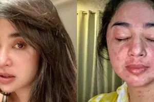 Potret 7 presenter wanita pede pamer wajah tak mulus, Melaney Ricardo sebut bopengnya bukan aib