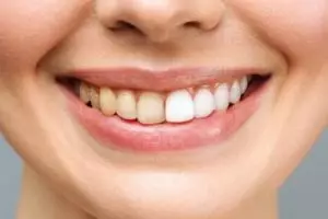 Noda kuning lenyap tanpa lemon, ini cara kembalikan warna putih pada gigi dengan 1 jenis buah-buahan