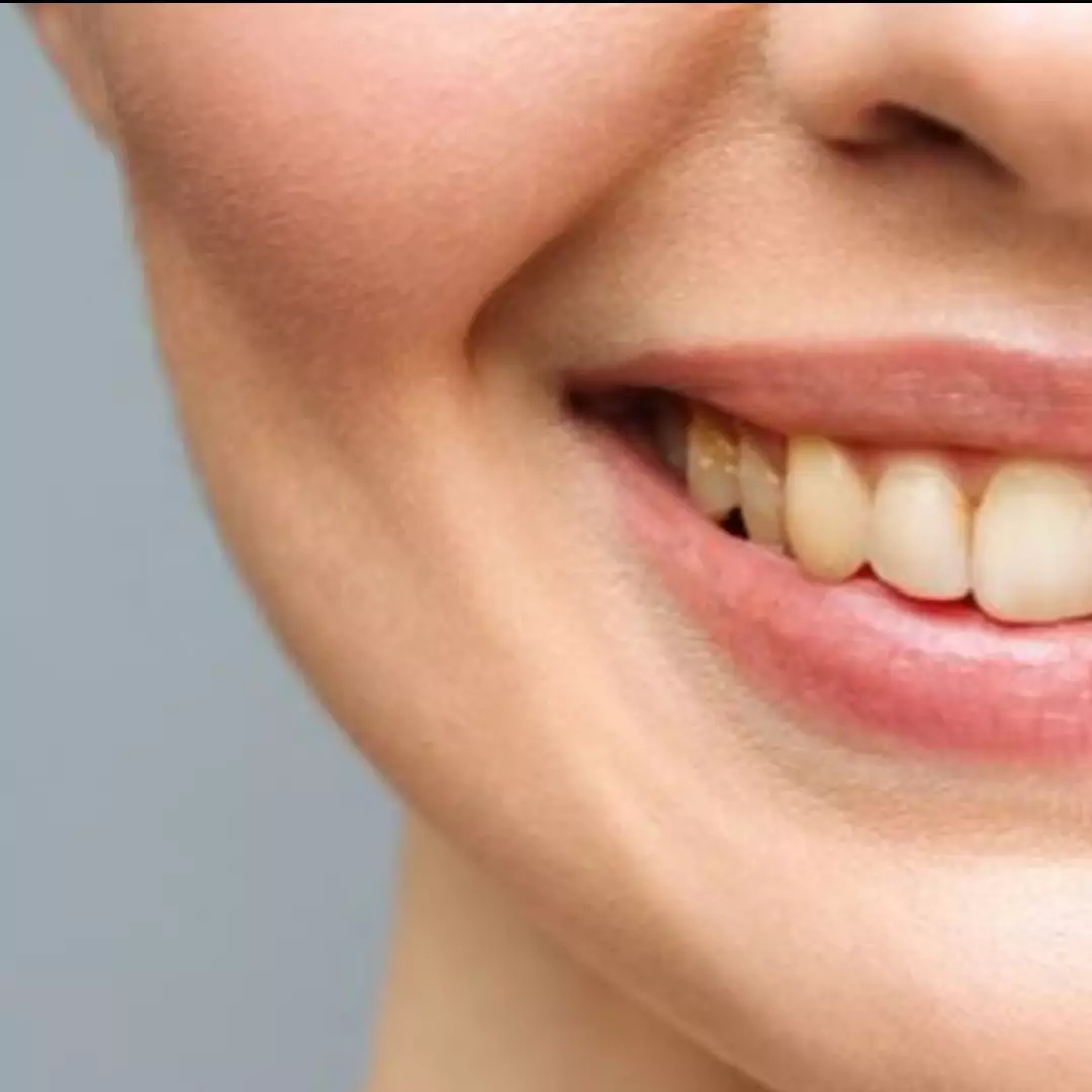 Noda kuning lenyap tanpa lemon, ini cara kembalikan warna putih pada gigi dengan 1 jenis buah-buahan