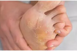 Tak perlu batu apung atau obat khusus, ini cara simpel hempaskan mata ikan hanya pakai 1 bumbu dapur