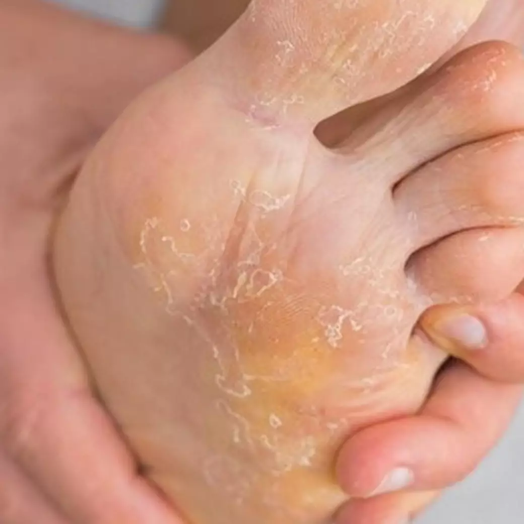 Tak perlu batu apung atau obat khusus, ini cara simpel hempaskan mata ikan hanya pakai 1 bumbu dapur