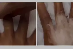 Tanpa kunyit, ini trik atasi kulit belang di jari akibat penggunaan cincin pakai 1 bahan masakan