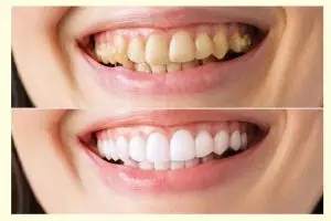 Tanpa perawatan ke dokter, ini trik rontokkan karang gigi dan atasi bau mulut hanya pakai 1 sayuran