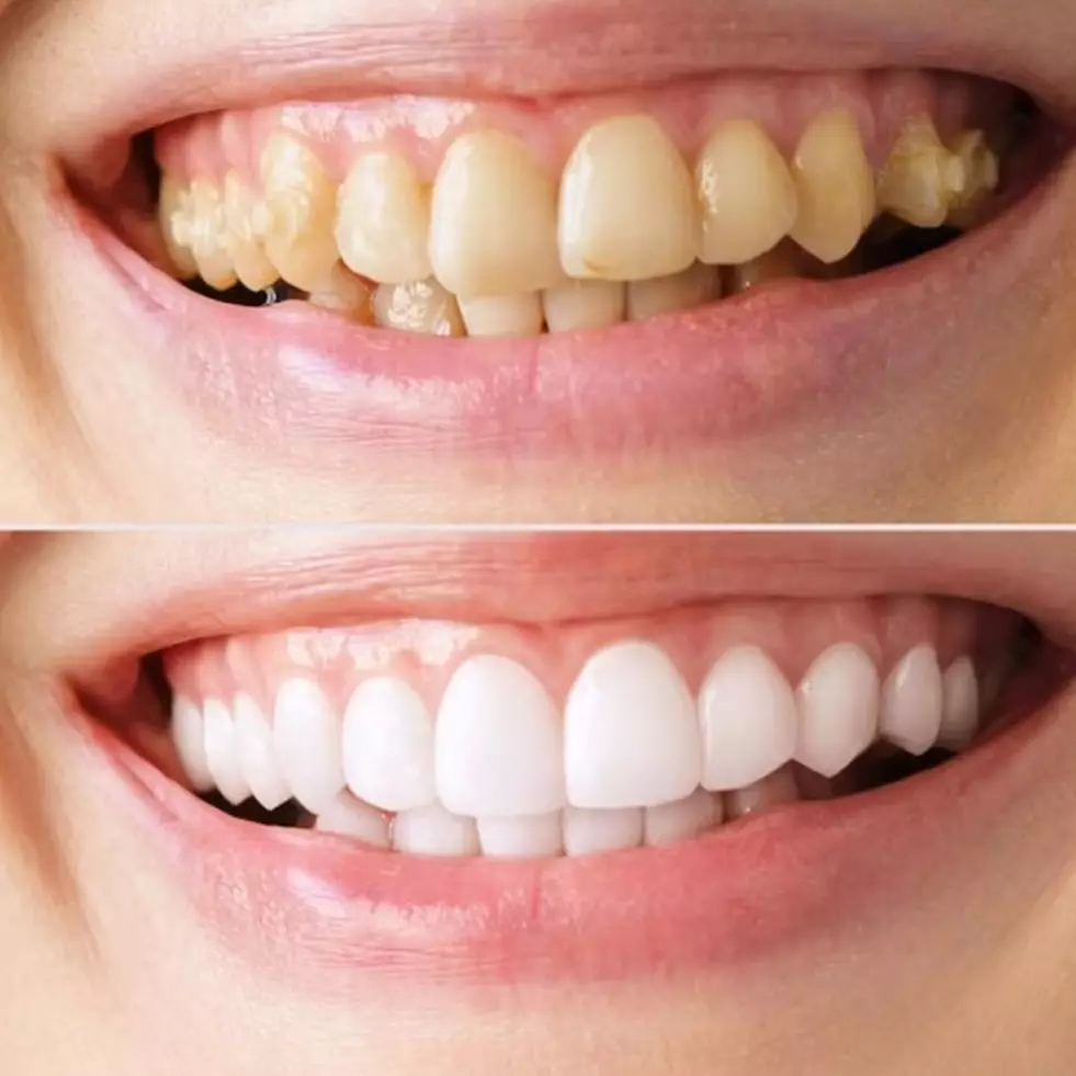 Tanpa perawatan ke dokter, ini trik rontokkan karang gigi dan atasi bau mulut hanya pakai 1 sayuran