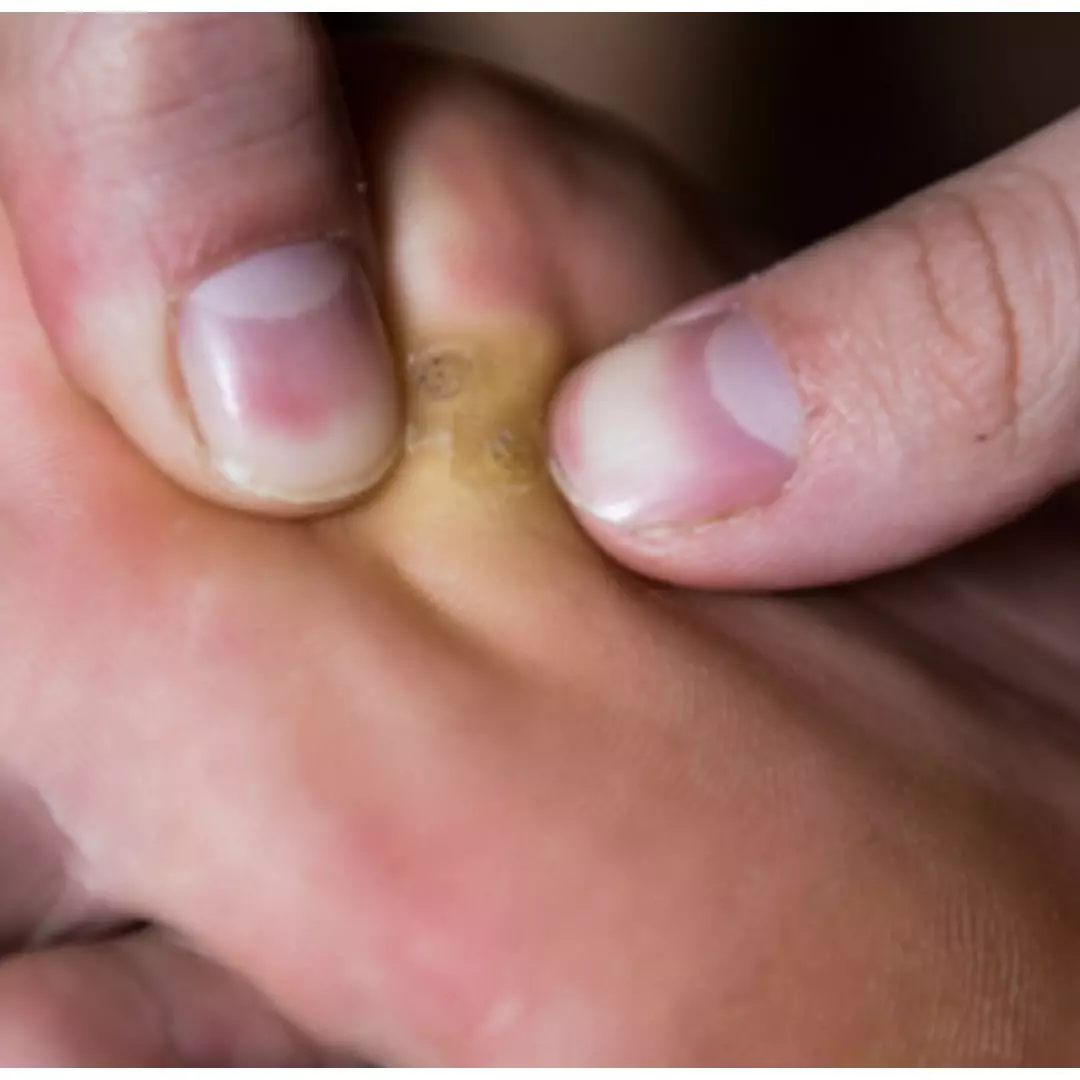 Tanpa operasi atau bawang putih, ini cara hilangkan mata ikan sampai ke akarnya pakai 1 jenis tanaman