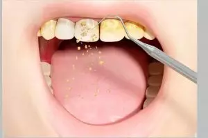 Tak perlu scaling, ini cara cegah munculnya noda kuning di permukaan gigi pakai 1 bahan alami