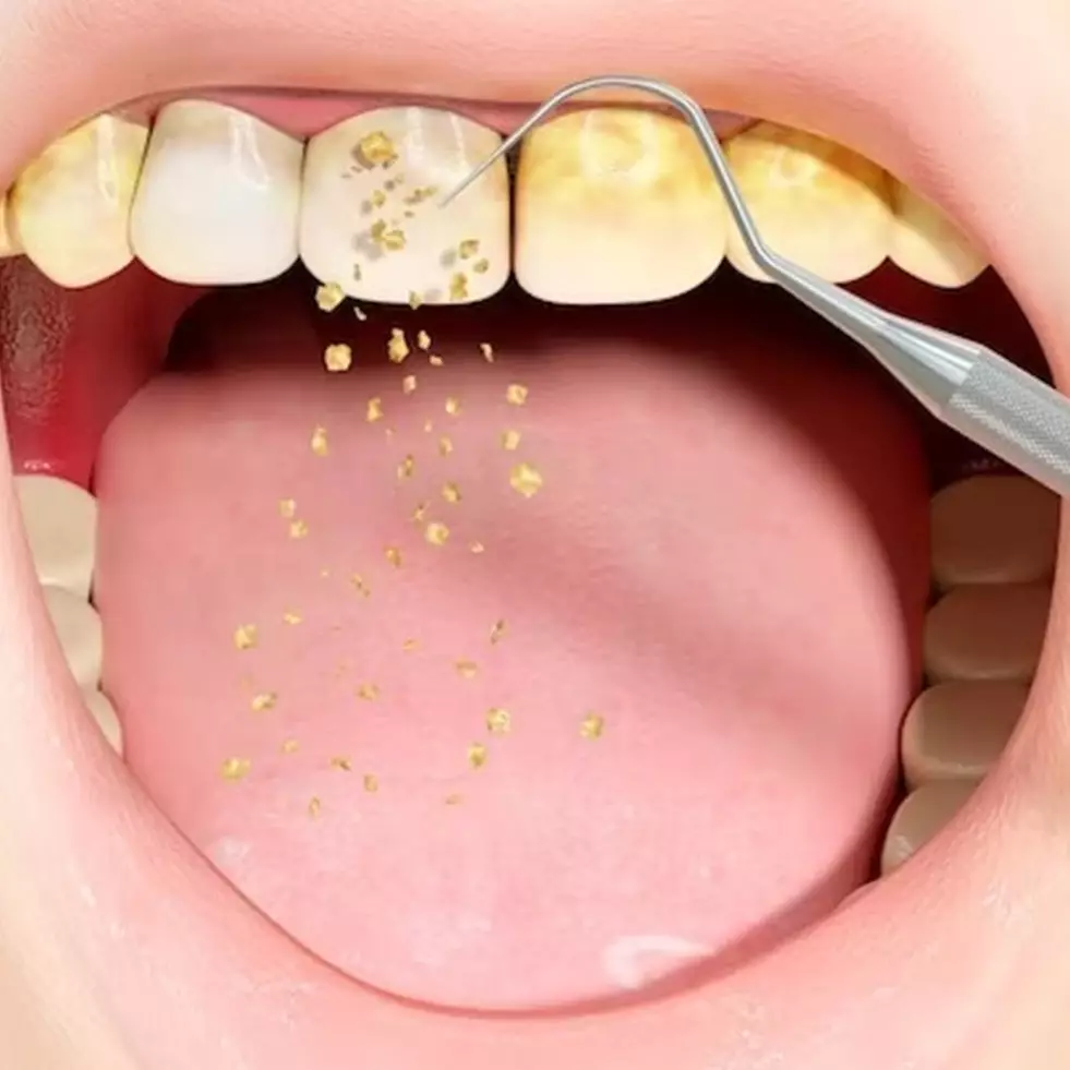 Tak perlu scaling, ini cara cegah munculnya noda kuning di permukaan gigi pakai 1 bahan alami