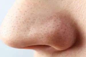 Tanpa tambahan kopi, ini trik hempas kotoran pada pori-pori penyebab komedo dengan 1 jenis buah-buahan