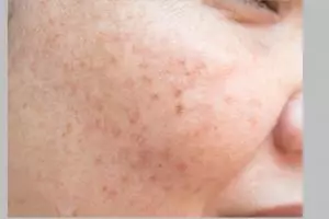 Tanpa perawatan mahal, ini cara atasi pigmentasi akibat penuaan dini pakai masker dari 1 jenis tepung