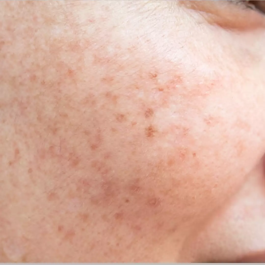 Tanpa perawatan mahal, ini cara atasi pigmentasi akibat penuaan dini pakai masker dari 1 jenis tepung