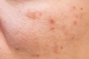 Tak perlu tambahan oatmeal, ini cara atasi jerawat dan pori-pori besar pakai 1 jenis bahan minuman