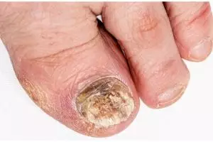 Tak perlu lemon, ini cara atasi kulit ujung jari retak dan kering menguning pakai 2 bahan alami