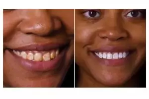 Tak hanya pakai baking soda, ini trik atasi noda kuning pada gigi dengan tambahan 1 jenis buah-buahan