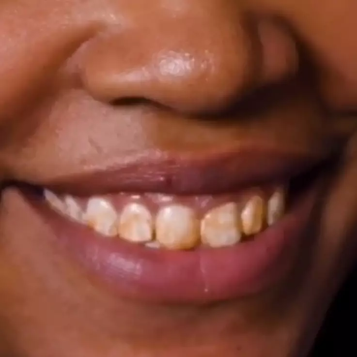 Tak hanya pakai baking soda, ini trik atasi noda kuning pada gigi dengan tambahan 1 jenis buah-buahan