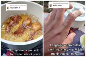 Tanpa pasta gigi, ini trik atasi kulit terkena minyak panas agar tak berbekas dengan 1 bahan dapur