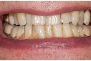 Nggak perlu produk pemutih, ini cara rontokkan plak kuning pada gigi hanya pakai 1 jenis tepung