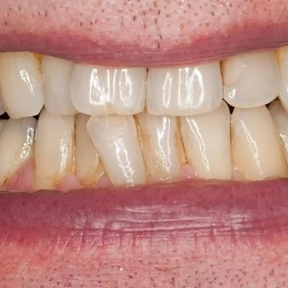 Nggak perlu produk pemutih, ini cara rontokkan plak kuning pada gigi hanya pakai 1 jenis tepung