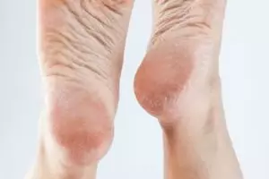 Tanpa tambahan lemon dan olive oil, ini trik haluskan kembali tumit pecah-pecah pakai 1 jenis minyak