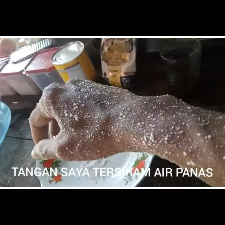 Cara atasi kulit yang tersiram air panas agar tak melepuh dan berbekas, cukup pakai 1 bumbu dapur
