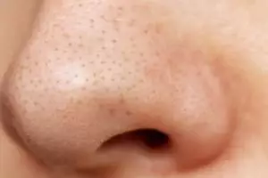 Cara bersihkan pori-pori tersumbat di hidung cuma pakai 1 jenis bahan makanan, komedo langsung lenyap
