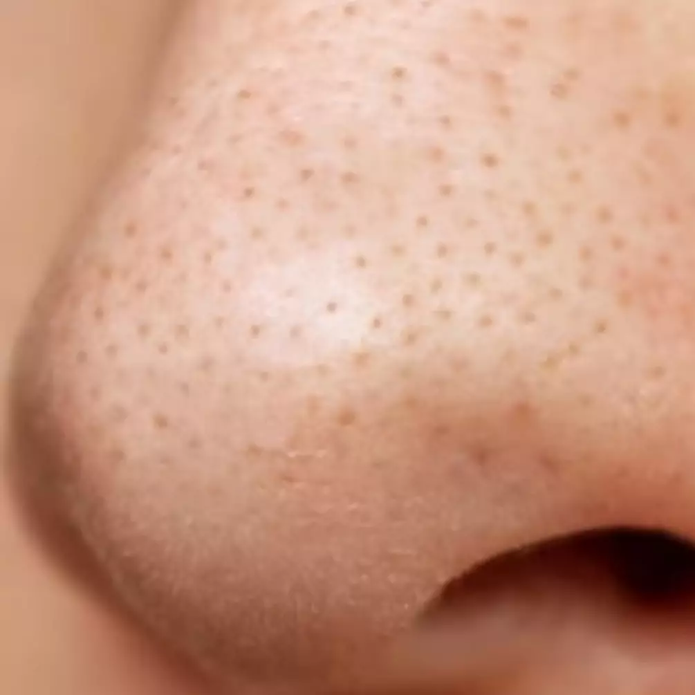 Cara bersihkan pori-pori tersumbat di hidung cuma pakai 1 jenis bahan makanan, komedo langsung lenyap