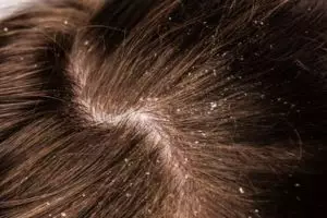 Tanpa tea tree oil, begini cara hempas ketombe penyebab kepala gatal pakai 1 jenis buah-buahan