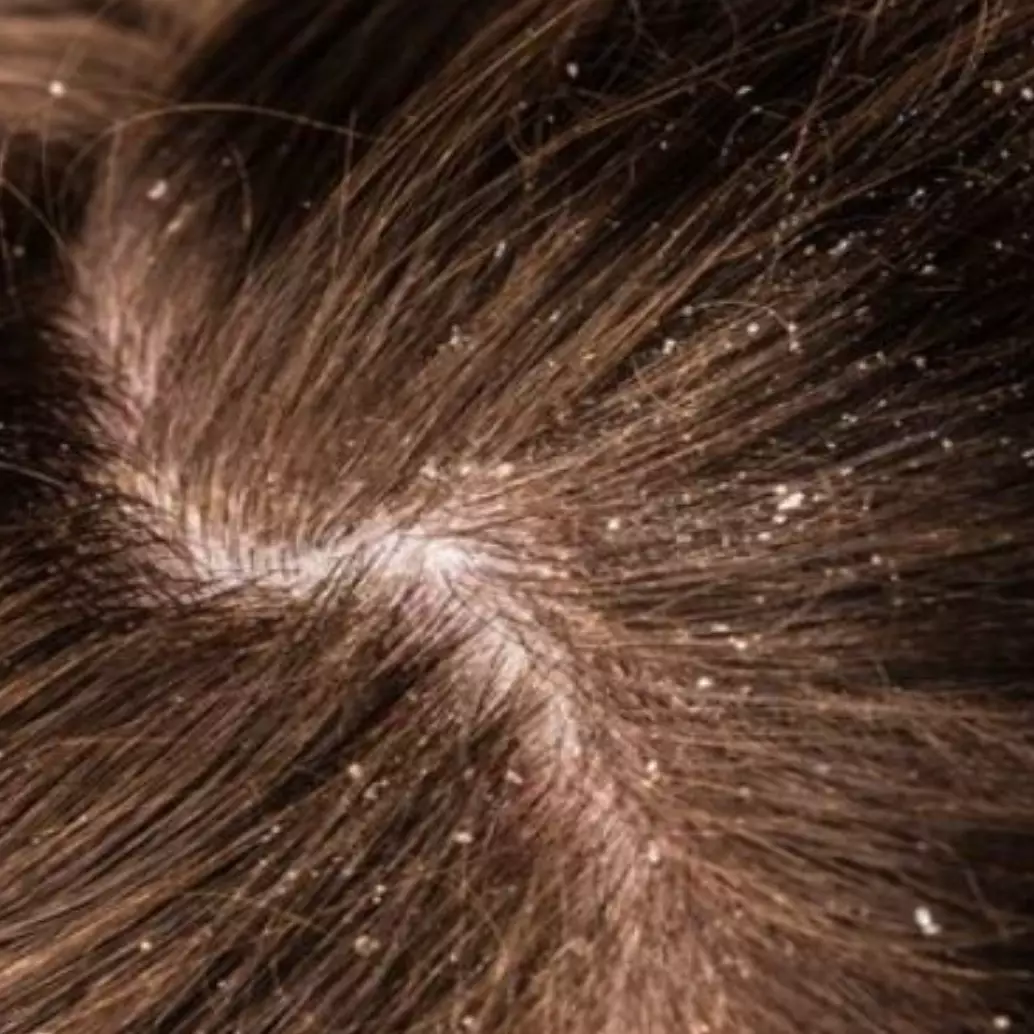 Tanpa tea tree oil, begini cara hempas ketombe penyebab kepala gatal pakai 1 jenis buah-buahan