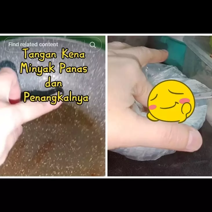 Tanpa pasta gigi atau madu, ini cara redakan kulit pedih terkena minyak panas pakai 1 bahan dapur