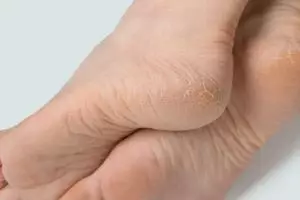 Tanpa tambahan madu, begini cara lembutkan tumit kasar dan pecah-pecah pakai 1 jenis tanaman hias