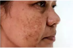 Tak perlu suntik vitamin, ini trik jitu memutihkan kulit kusam penuh flek hitam pakai 1 jenis minuman