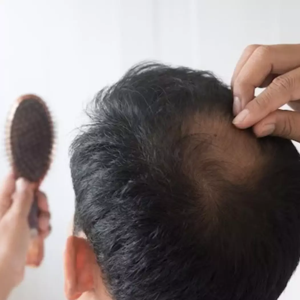 Tanpa bawang, ini cara bikin area rambut pitak kembali tumbuh lebat manfaatkan 1 jenis rempah