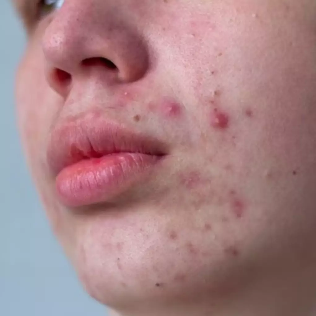 Jangan dipencet, ini cara hilangkan jerawat biar nggak balik lagi pakai 1 jenis buah