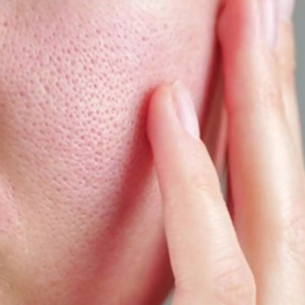 Tanpa timun dan air mawar, ini trik mengecilkan pori-pori agar wajah bebas minyak pakai 1 jenis bunga