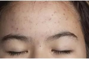 Tanpa gunakan lemon, ini cara hilangkan jerawat pasir di dahi agar kulit auto mulus pakai 1 jenis daun