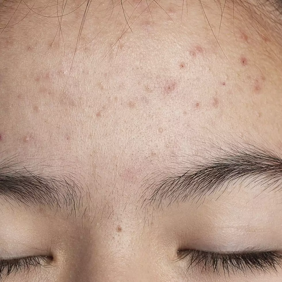 Tanpa gunakan lemon, ini cara hilangkan jerawat pasir di dahi agar kulit auto mulus pakai 1 jenis daun