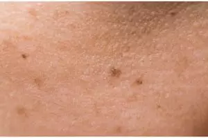 Nggak perlu tepung beras, ini trik samarkan flek hitam pakai face wash dari 2 bahan alami