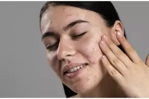 Tanpa air beras, ini cara memutihkan pigmentasi akibat bekas jerawat pakai 1 jenis tepung