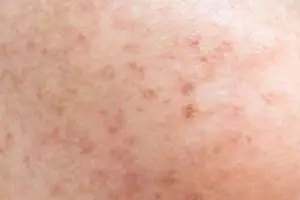 Trik atasi flek hitam di wajah pakai 1 jenis minuman, autoputih glowing dan bebas noda