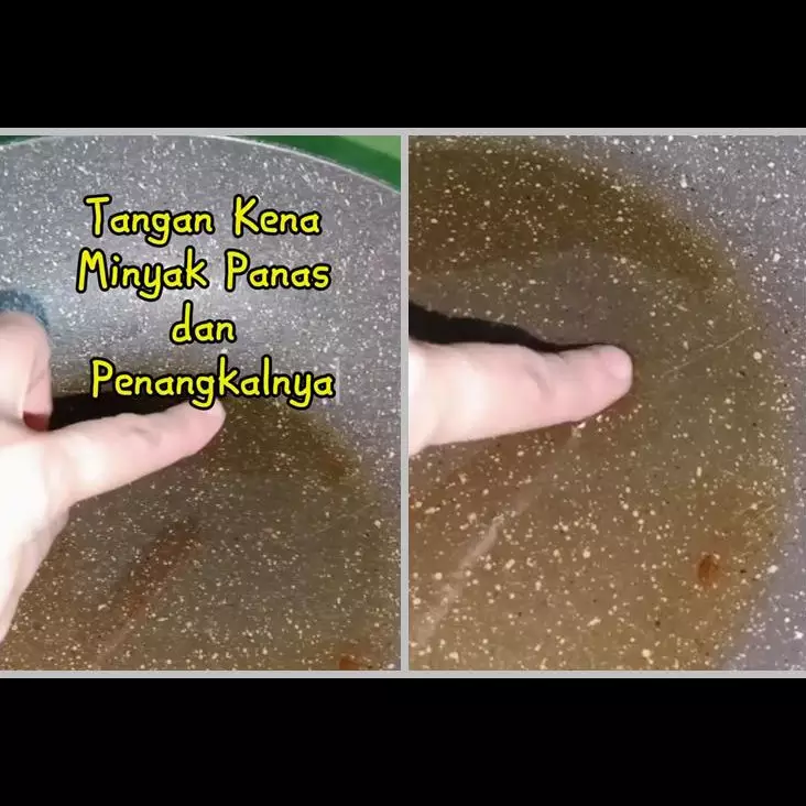 Bukan madu, ini cara mengatasi tangan terkena minyak panas agar tak melepuh cuma pakai 1 bahan dapur