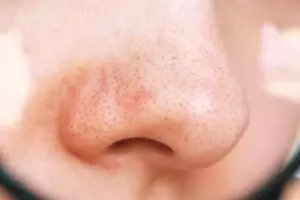 Tak perlu tambahan lemon, ini cara atasi pori wajah tersumbat penyebab komedo pakai 1 bahan dapur