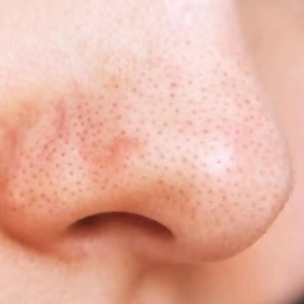 Tak perlu tambahan lemon, ini cara atasi pori wajah tersumbat penyebab komedo pakai 1 bahan dapur