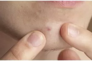 Trik hempaskan komedo di area dagu pakai masker dari 1 jenis tepung, auto bersih & bebas bintik hitam