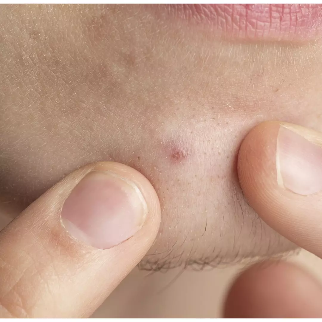 Trik hempaskan komedo di area dagu pakai masker dari 1 jenis tepung, auto bersih &amp; bebas bintik hitam