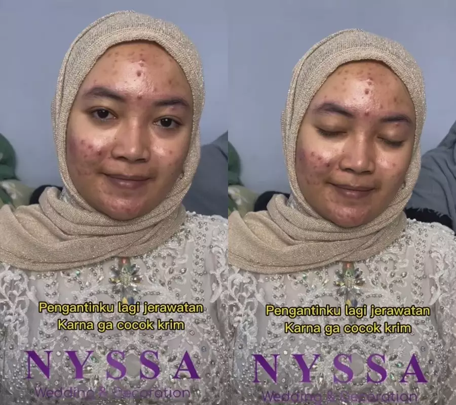 wajah pengantin jerawatan jadi mulus usai makeup © 2023 brilio.net